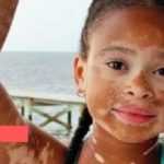Medias241.com-Gabon-VITILIGO : LA COMMUNAUTÉ VITIUM SUR FACEBOOK DÉMYSTIFIE LA MALADIE